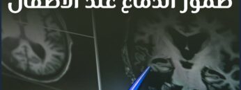 ضمور الدماغ