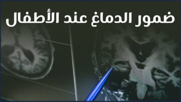 ضمور الدماغ