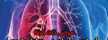 مرض ذات الرئ