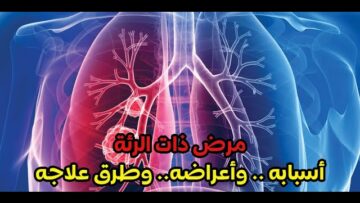 مرض ذات الرئ